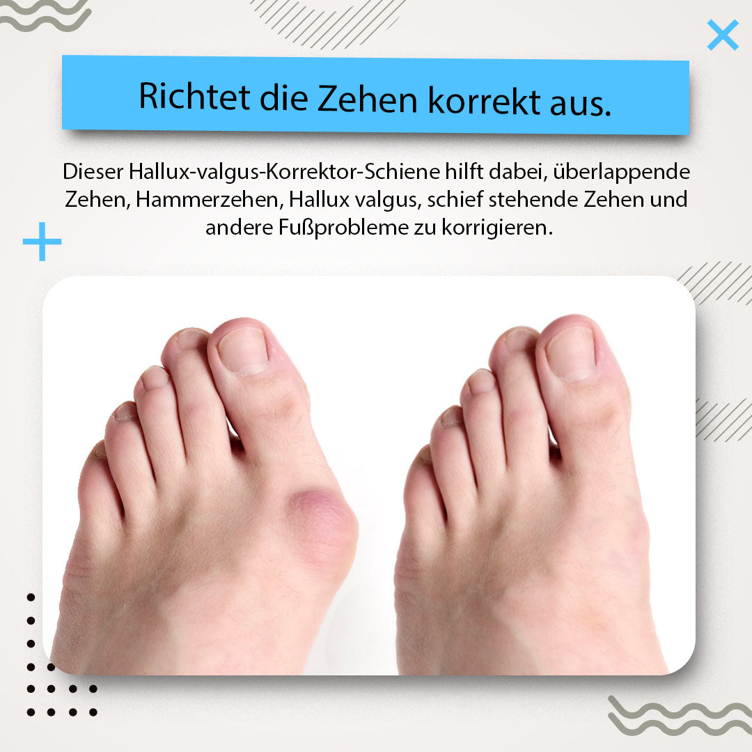 Alayna™ 3D Sofortige Hallux Valgus Schiene 🔥Meistverkauft🔥